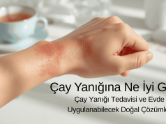 Çay Yanığına Ne İyi Gelir? | Çay Yanığı Tedavisi ve Evde Uygulanabilecek Doğal Çözümler